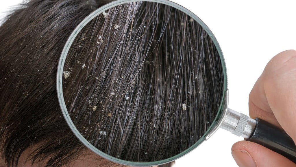 Mengenal Apa Saja Obat Ketombe Alami: Ada Lidah Buaya & Omega-3 Mengenal Apa Saja Obat Ketombe Alami: Ada Lidah Buaya & Omega-3