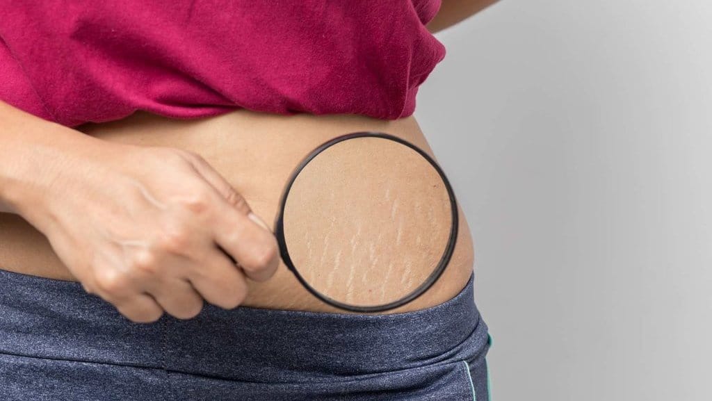 Cara Menghilangkan Stretch Mark Saat Hamil dengan Minyak Zaitun