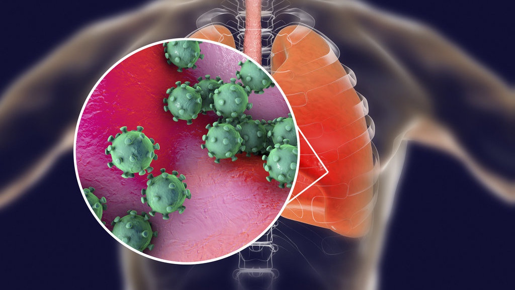 Mengapa Banyak Pasien Coronavirus COVID-19 Meninggal di Italia? Mengapa Banyak Pasien Coronavirus COVID-19 Meninggal di Italia?