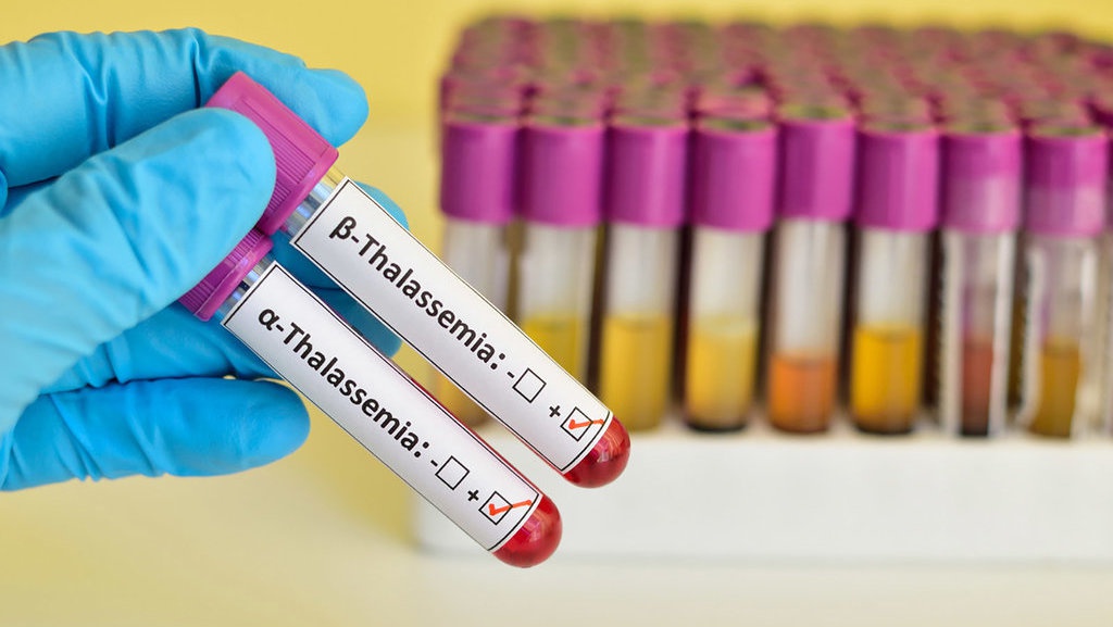 Thalasemia Mayor vs Minor: Ciri-ciri dan Cara Mencegahnya
