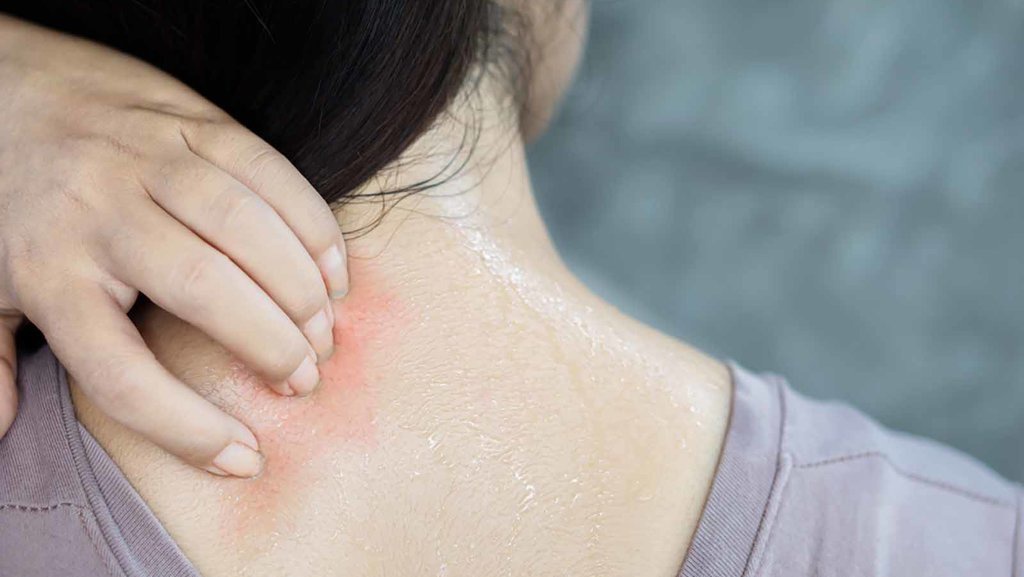 Cara Mengatasi Iritasi Kulit dengan Bahan-Bahan Alami Cara Mengatasi Iritasi Kulit dengan Bahan-Bahan Alami