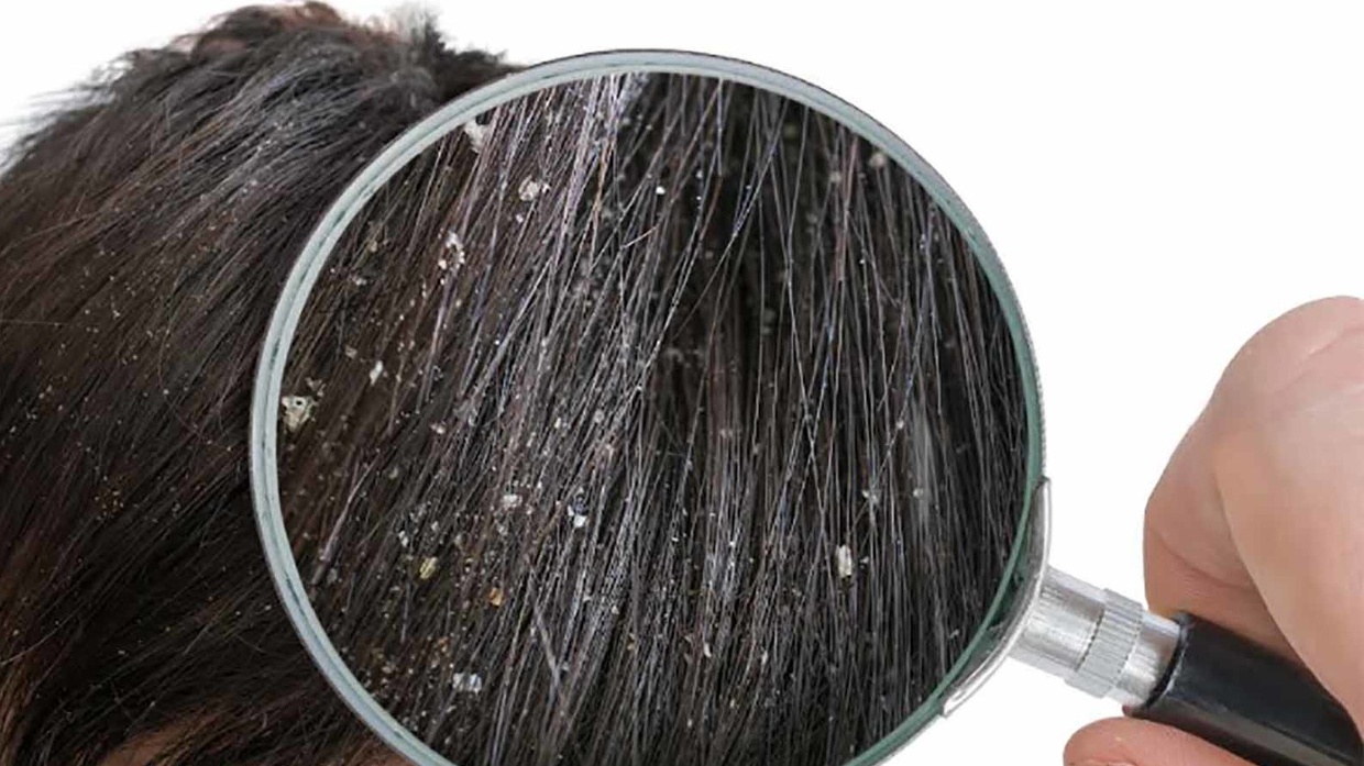 Eh, Tau Gak Ketombe Menyerang Nyaris Setengah Populasi Manusia? 