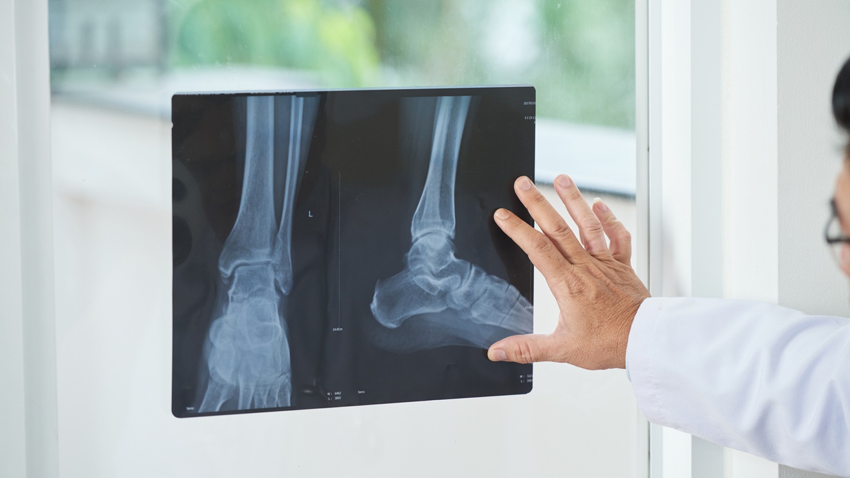 Apa Itu Penyakit Rakitis, Gejala, Penyebab, & Pengobatannya?