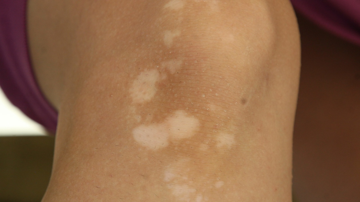 Mengenal Penyakit Panu, Penyebab, Gejala, dan Obat Alaminya Mengenal Penyakit Panu, Penyebab, Gejala, dan Obat Alaminya