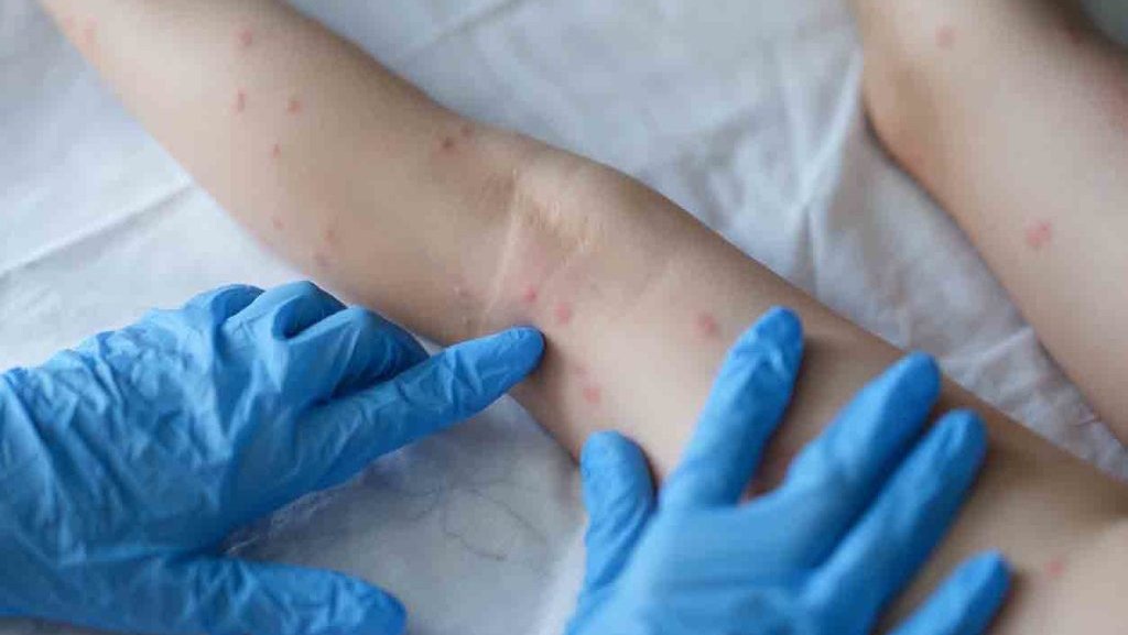 Epidemiolog UI Sebut Pasien Cacar Monyet Aman untuk Isoman di Rumah Epidemiolog UI Sebut Pasien Cacar Monyet Aman untuk Isoman di Rumah