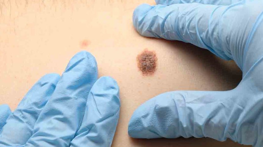 Cara Mudah Deteksi Kanker Kulit: Apa Tanda yang Perlu Diwaspadai? Cara Mudah Deteksi Kanker Kulit: Apa Tanda yang Perlu Diwaspadai?