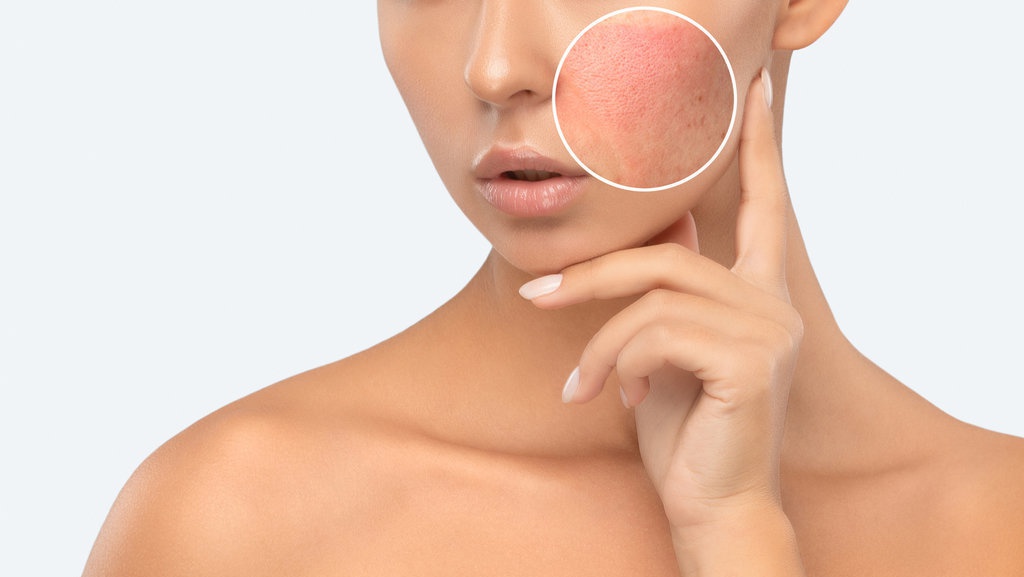 Mengenal Kulit Sensitif dan Bagaimana Cara Merawatnya Mengenal Kulit Sensitif dan Bagaimana Cara Merawatnya