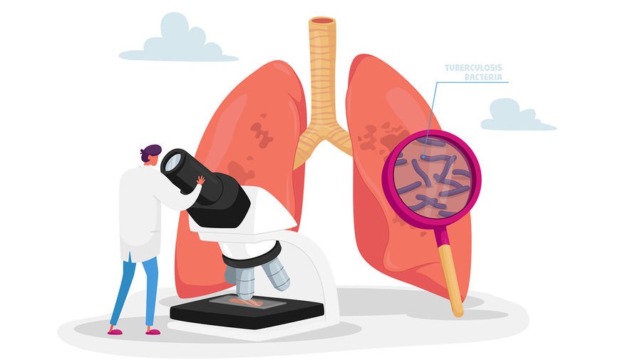Tuberkulosis di Indonesia: Siapa yang Paling Rentan Terkena TBC? Tuberkulosis di Indonesia: Siapa yang Paling Rentan Terkena TBC?