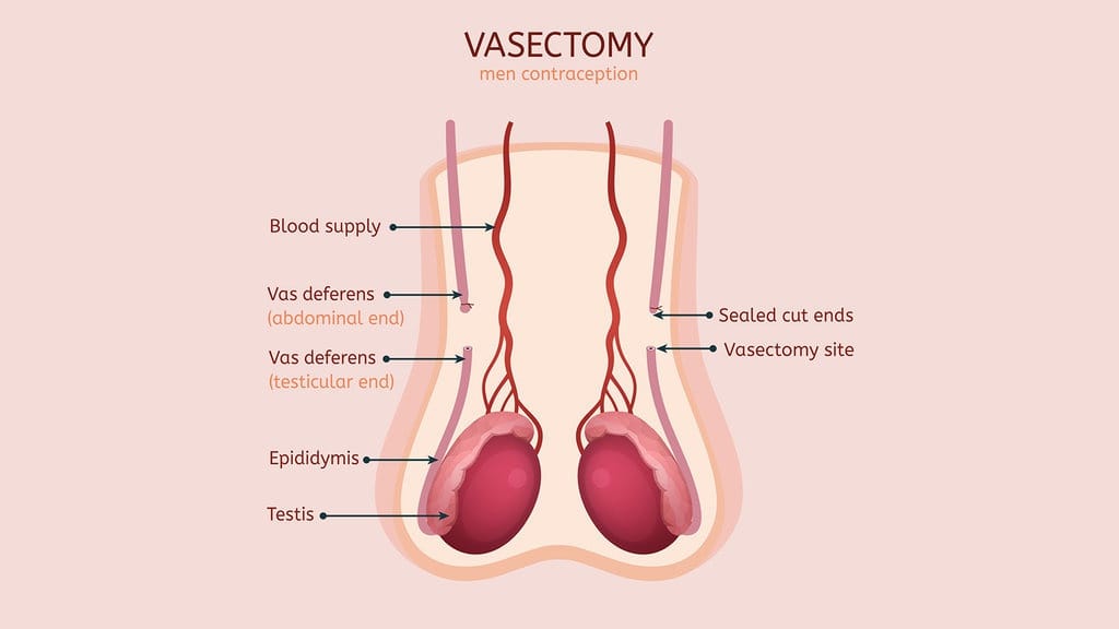 Syarat Vasektomi di Indonesia, Aturan dan Prosedurnya
