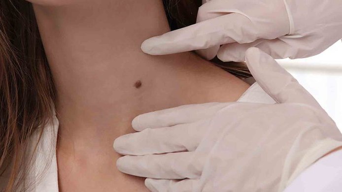 Perbedaan Kista dan Tumor, Apakah Bisa Berubah Jadi Kanker? Perbedaan Kista dan Tumor, Apakah Bisa Berubah Jadi Kanker?