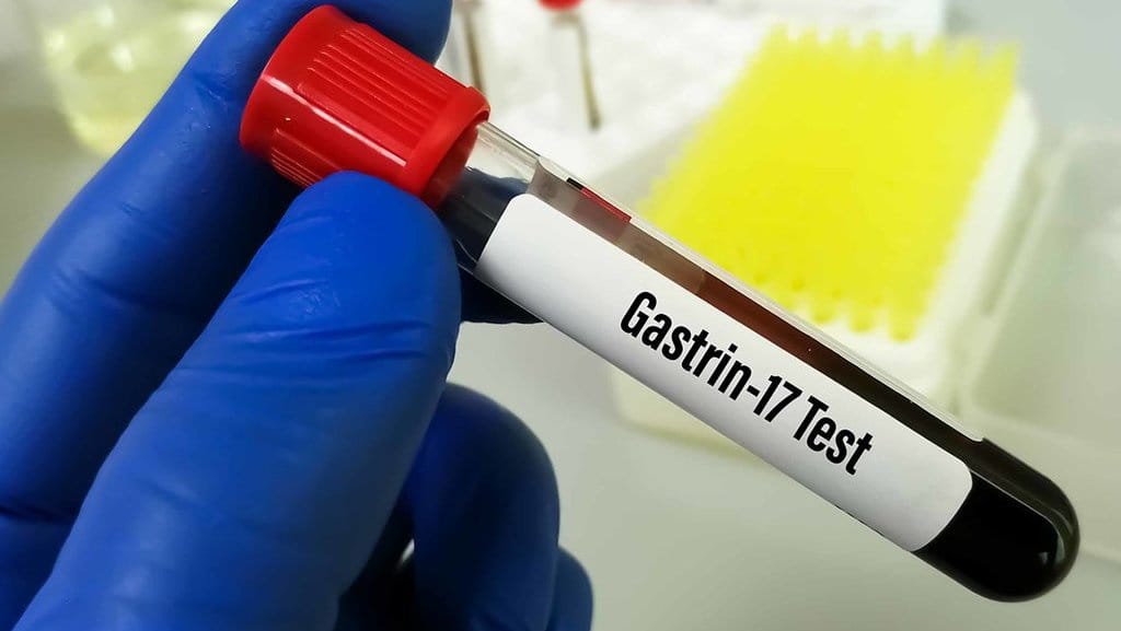 Mengenal Apa Itu Sindrom Zollinger Ellison, Penyebab & Gejalanya