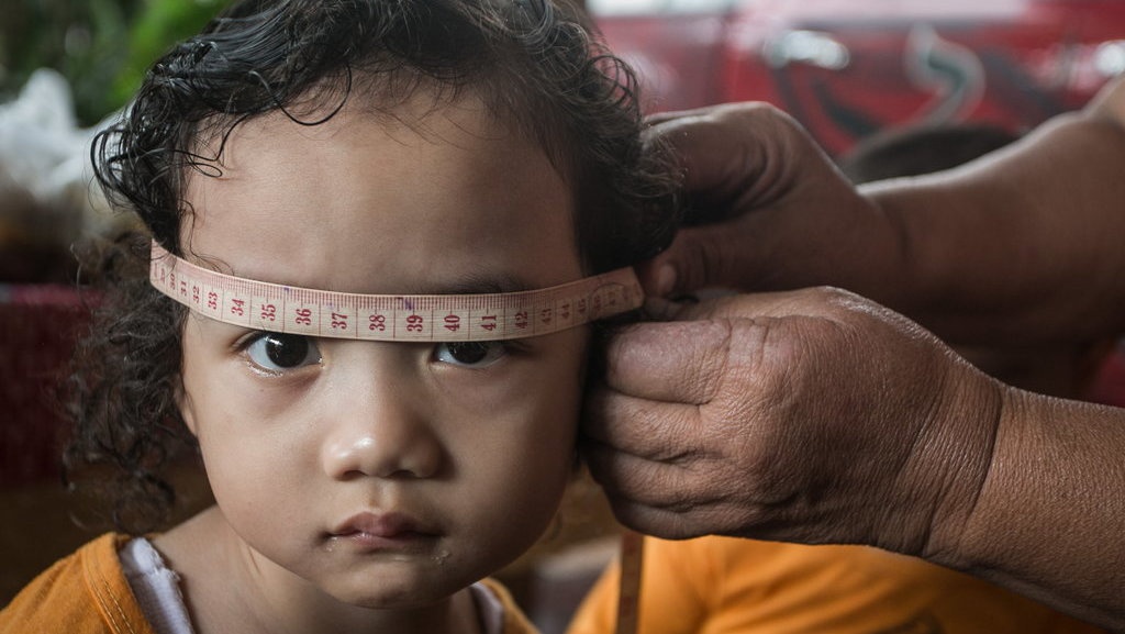 Ciri-ciri Stunting pada Anak 2 Tahun dan Vitamin yang Dibutuhkan Ciri-ciri Stunting pada Anak 2 Tahun dan Vitamin yang Dibutuhkan