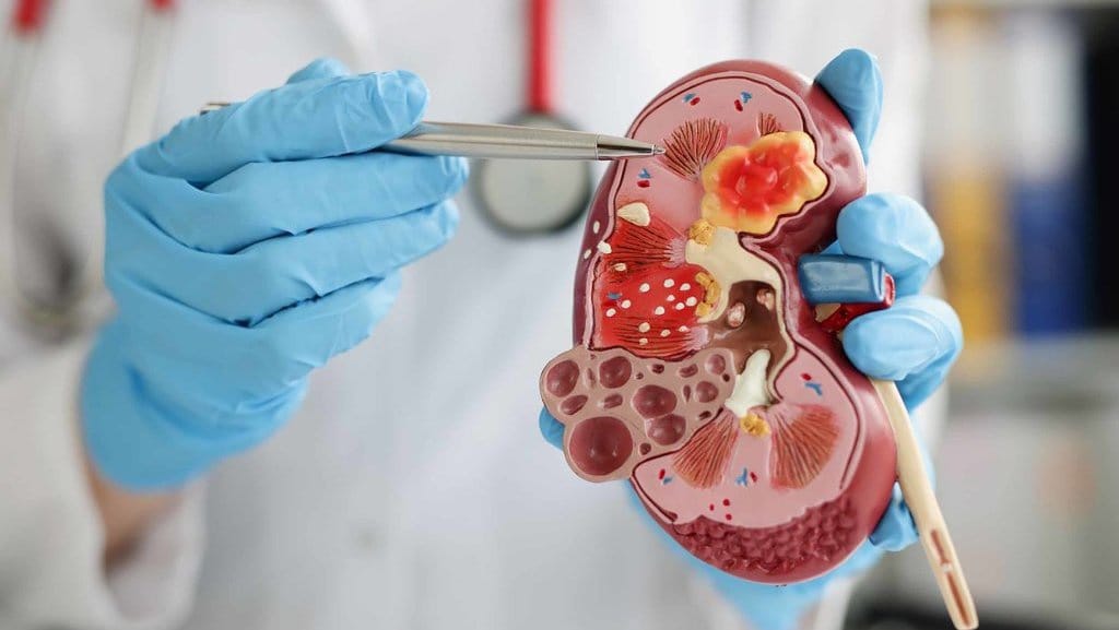 Apa Hukuman Pidana Menjual Ginjal Secara Ilegal di Indonesia?