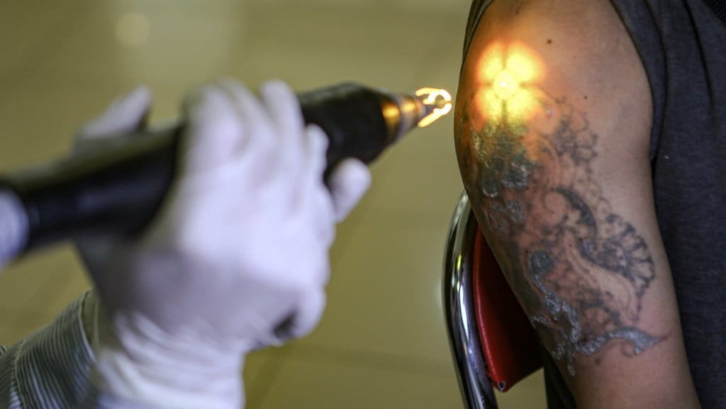 Bisakah Tato Seperti Milik Rendy Kjaernett Dihapus & Risikonya? Bisakah Tato Seperti Milik Rendy Kjaernett Dihapus & Risikonya?