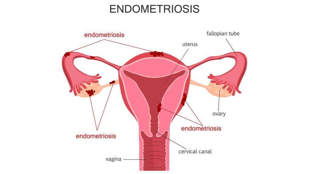 Pola Makan Penderita Endometriosis yang Perlu Diketahui Wanita Pola Makan Penderita Endometriosis yang Perlu Diketahui Wanita