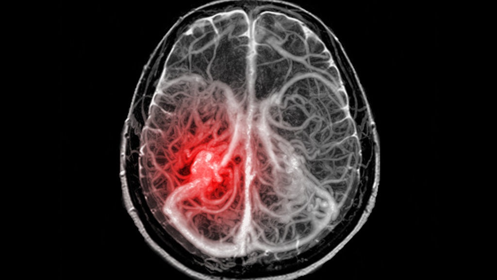 Apakah Aneurisma Otak Berbahaya dan Bagaimana Pengobatannya? Apakah Aneurisma Otak Berbahaya dan Bagaimana Pengobatannya?