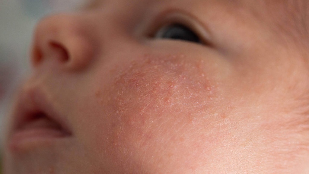 Ketahui 4 Penyebab Milia pada Bayi dan Cara Mengatasinya