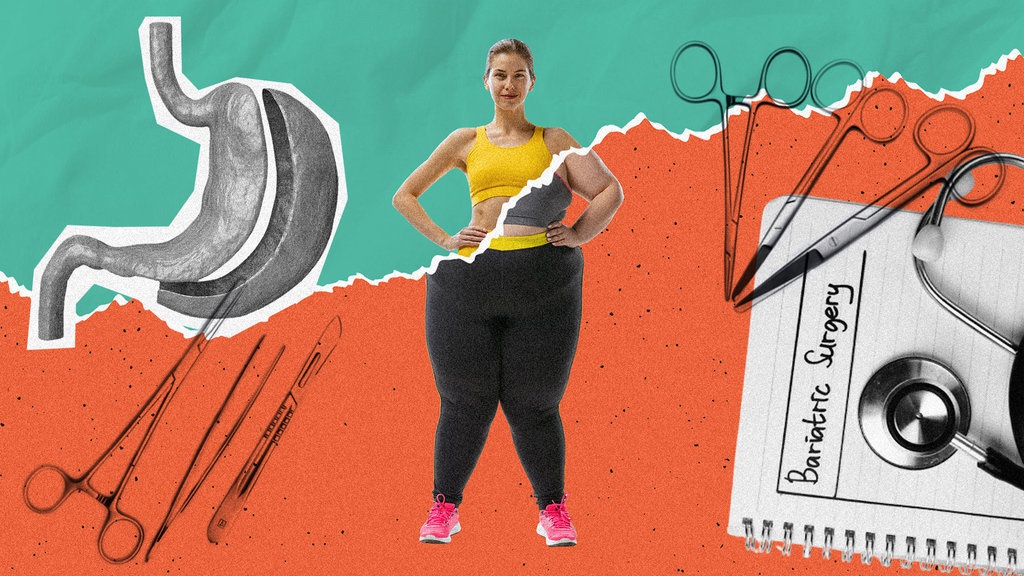 Bedah Bariatrik sebagai Alternatif Lain Melawan Obesitas Bedah Bariatrik sebagai Alternatif Lain Melawan Obesitas