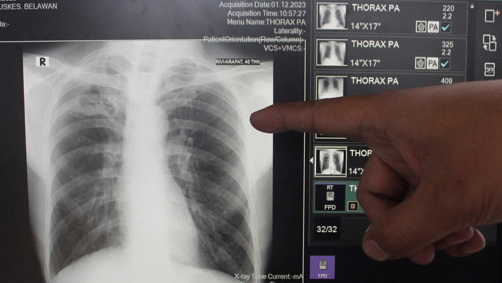 Mengenal Vaksin TBC Bill Gates M72, Akan Diuji Coba di RI?