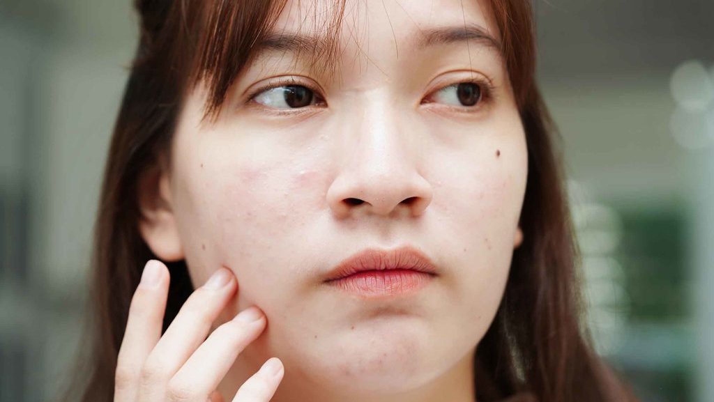 Penyebab Bekas Jerawat Susah Hilang dan Cara Mengatasinya Penyebab Bekas Jerawat Susah Hilang dan Cara Mengatasinya