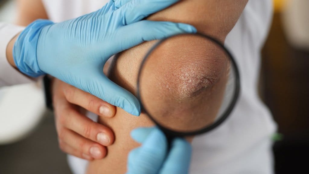 15 Penyebab Siku Kering dan Hitam Beserta Cara Mengatasinya 15 Penyebab Siku Kering dan Hitam Beserta Cara Mengatasinya