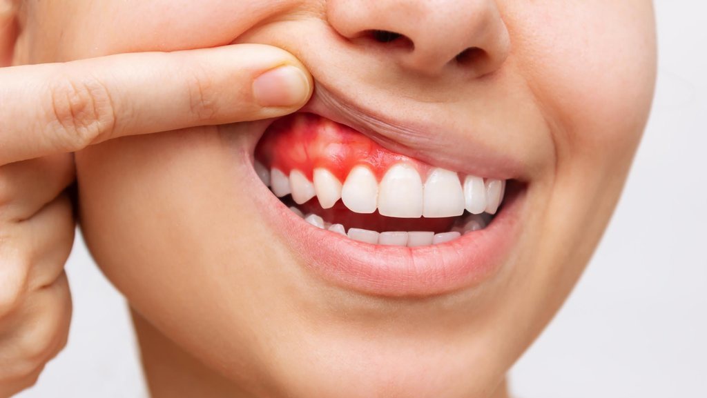 8 Penyebab Gusi Putih dan Sakit seperti Gejala Seriawan 8 Penyebab Gusi Putih dan Sakit seperti Gejala Seriawan