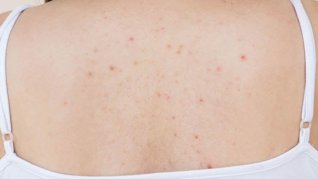 9 Penyebab Jerawat di Badan dan Cara Mengatasinya