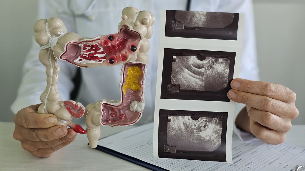 Kanker Usus Besar di Usia Muda: Gen Z & Millenial Perlu Pahami Kanker Usus Besar di Usia Muda: Gen Z & Millenial Perlu Pahami