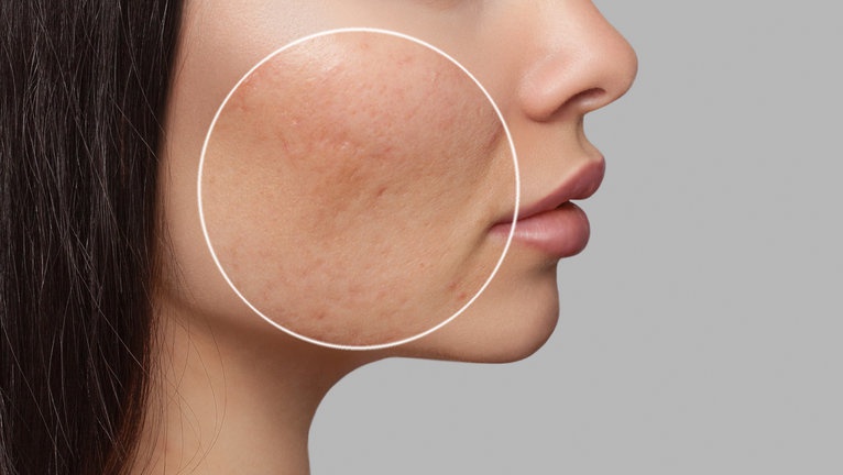 Perbedaan Bekas Jerawat PIE dan PIH Beserta Cara Mengatasinya Perbedaan Bekas Jerawat PIE dan PIH Beserta Cara Mengatasinya