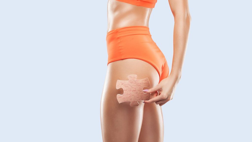 8 Cara Mencegah Stretch Mark pada Tubuh Secara Alami 8 Cara Mencegah Stretch Mark pada Tubuh Secara Alami