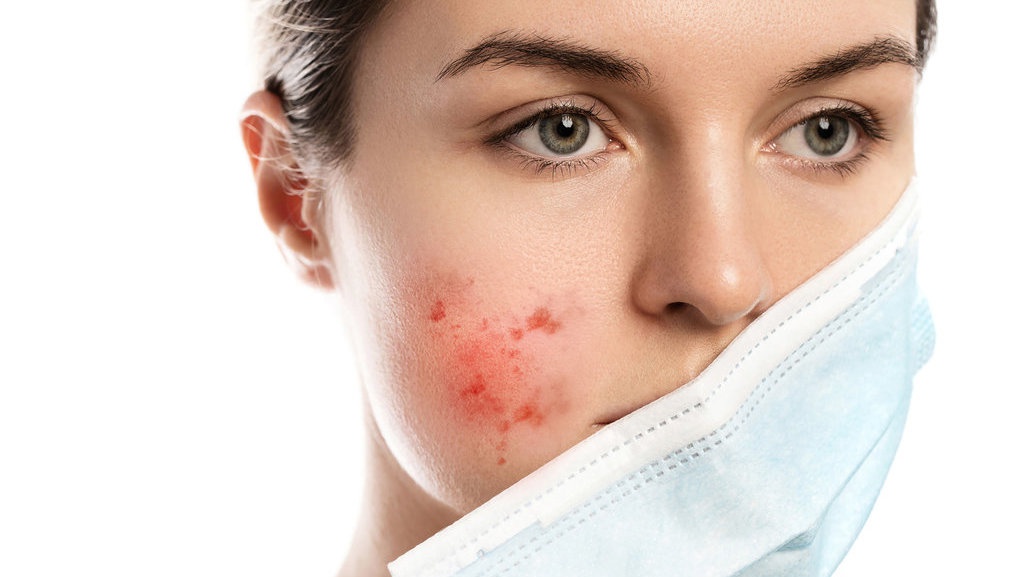 Apakah Pakai Masker Bisa Menyebabkan Jerawat & Bopeng di Wajah? Apakah Pakai Masker Bisa Menyebabkan Jerawat & Bopeng di Wajah?