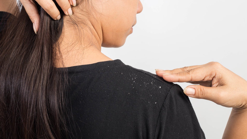 7 Shampo Penghilang Ketombe Paling Bagus & Ampuh 7 Shampo Penghilang Ketombe Paling Bagus & Ampuh