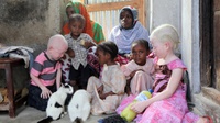 Perburuan Albino di Afrika