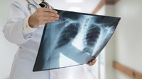 Ketahui 5 Cara untuk Menjaga Kesahatan Paru-paru