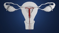 Mengenal IUD, Jenis Kontrasepsi Spiral untuk Menunda Kehamilan