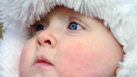 ASI Bukan Penyebab Ruam Susu pada Bayi, Ketahui Cara Mengobatinya