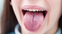 'COVID Tongue' atau Bercak Lidah Jadi Gejala Baru Corona, Kata Ahli