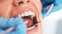 8 Jenis Perawatan untuk Kerusakan Gigi, Implan Hingga Dental Braces