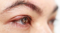 Penyebab Bintitan Mata dan Cara Serta Obat Alami Atasi Bintitan