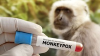 Kasus Monkeypox di RI Bertambah Jadi 17 Pasien: Semuanya Lelaki