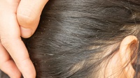 8 Cara Menghilangkan Kutu Rambut pada Anak