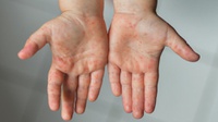 Campak dan Difteri yang Berujung Penyakit Komplikasi pada Anak