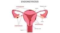 Pola Makan Penderita Endometriosis yang Perlu Diketahui Wanita
