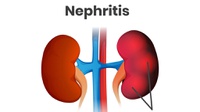 Mengenal Penyakit Nefritis, Gejala, Penyebab & Cara Mencegahnya
