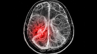 Apakah Aneurisma Otak Berbahaya dan Bagaimana Pengobatannya?