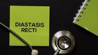 Mengenal Diastasis Recti, Kondisi Perut Tak Rata Usai Melahirkan