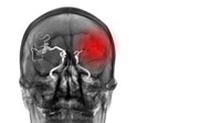 12 Gejala Pendarahan Otak yang Perlu Diwaspadai, Apa Penyebabnya