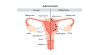 Mengenal Apa Itu Adenomiosis, Penyakit Reproduksi Wanita