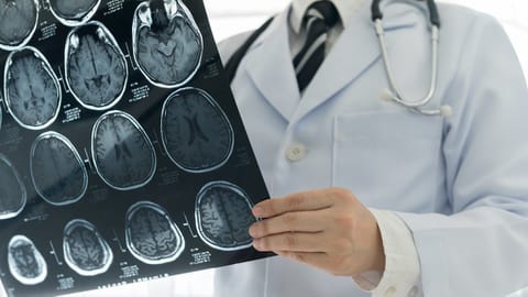 Risiko Stroke Tak Kenal Usia, Kenapa dan Harus Bagaimana?