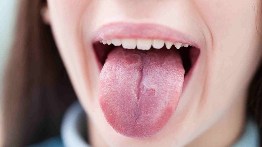 Mengenal Penyakit Geographic Tongue Yang Menyerang Lidah